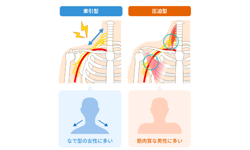 胸郭出口症候群のタイプ別